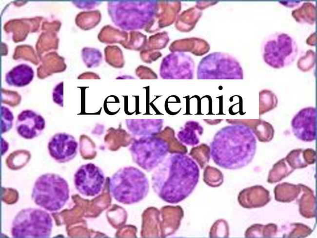 Leukemia Adalah Kanker yang Menyerang Sel Darah, Pahami Gejala dan Penyebabnya